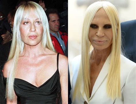 Donatella Versace Before and After Plastic Surgery.